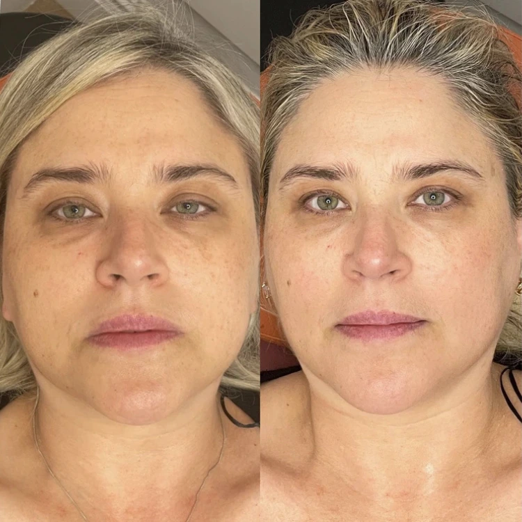 Before and After Gallery: Microneedling Banner