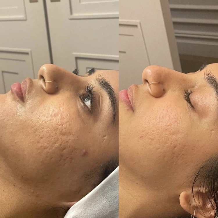 Before and After Gallery: Microneedling Banner