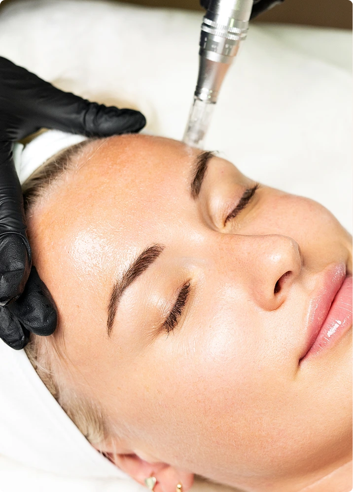 What Is Microneedling? Banner